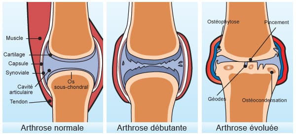 Trois coupes de genou légendées arthrose normale, débutante et évoluée